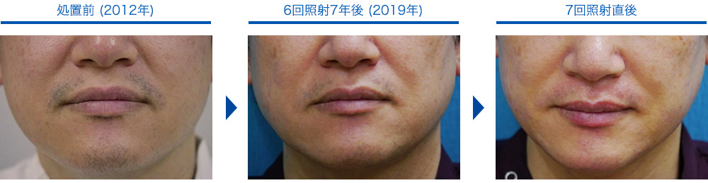 メンズ脱毛の症例