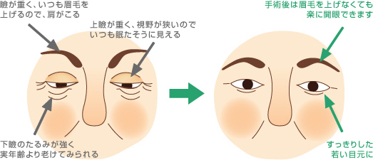 眼瞼下垂手術（眉毛）