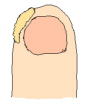”いぼ”いろいろ