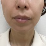 ボトックスで横顔美人に