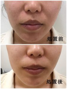 ハイフ(HIFU、高密度焦点式超音波)　ウルトラセルＱ＋ 1回の効果