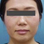 1回の処置で理想の輪郭と－5歳肌を目指すには！？