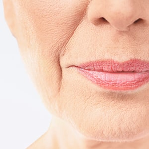 表情じわ・小じわ