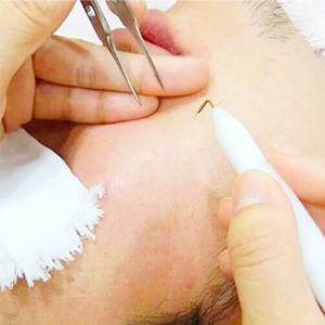 絶縁針脱毛