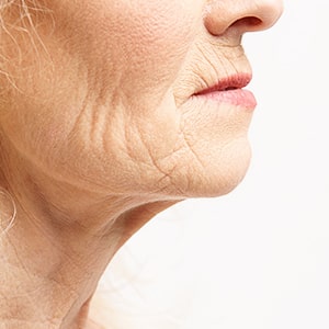 しわ・たるみ（ヒアルロン酸注射）