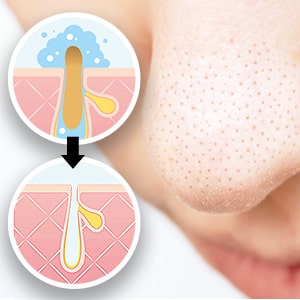 毛穴の開き・詰まり・黒ずみ