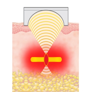 （HIFU／ハイフ）ウルトラセルZi リニア