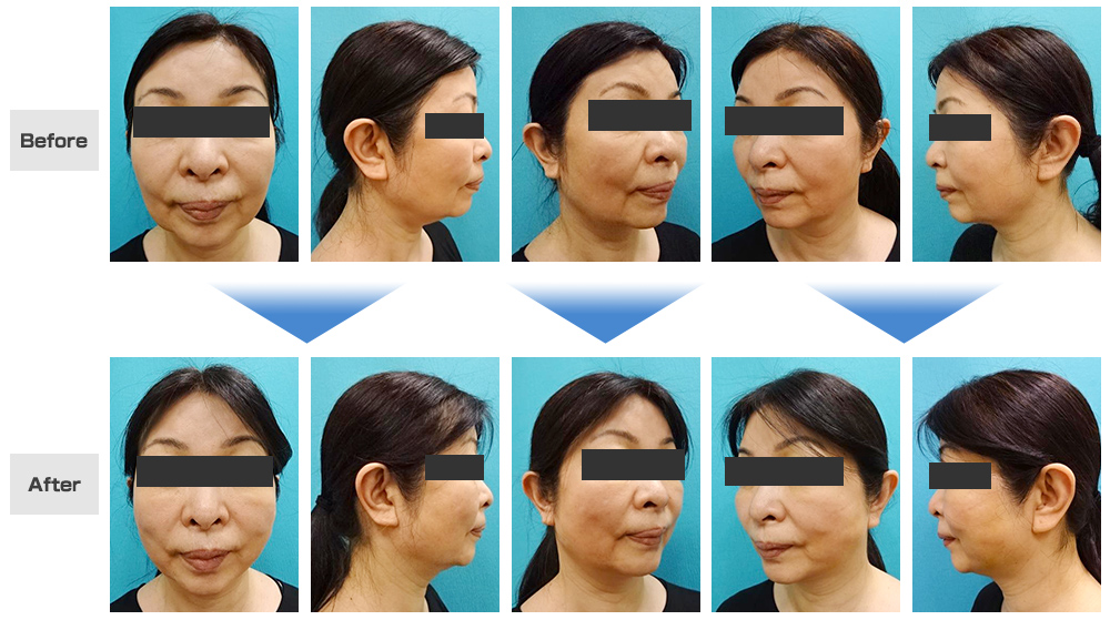 MWデュアルリフト治療症例