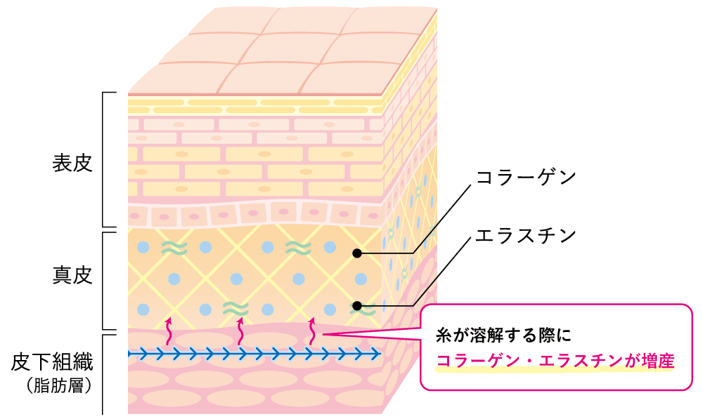 糸が溶解する際、周辺組織でコラーゲンやエラスチンが増産