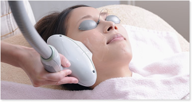 シミ治療「フォトブライト」 フォトブライト 開始