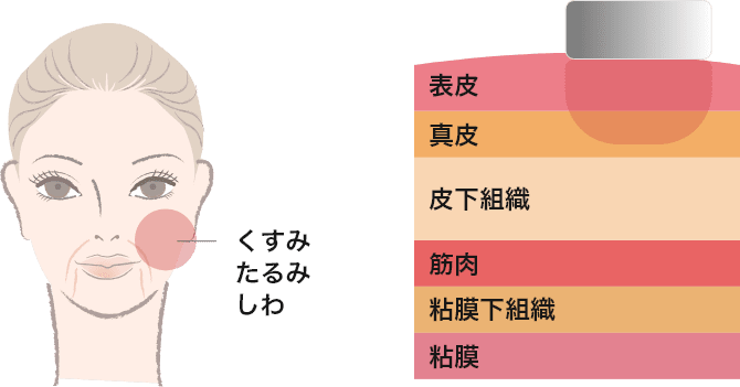 FRAC3&reg;（スムーストーニング）