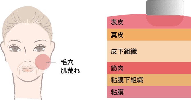 SupErficial&trade;（スムースピール）