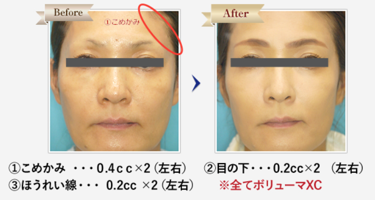 ヒアルロン酸注射治療症例