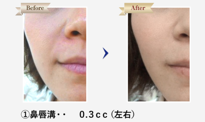 ヒアルロン酸注射治療症例