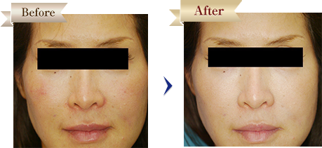 ヒアルロン酸注射治療症例