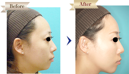 ヒアルロン酸注射＋ボトックス注射治療症例