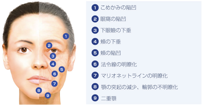 老化による組織位置変化を考慮したボリューム補填が重要
