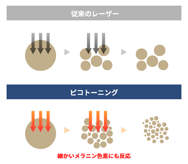 ピコトーニング（くすみや肝斑に）