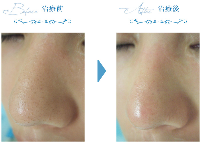 毛穴施術の症例