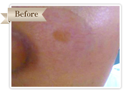 Qスイッチルビーレーザーの症例