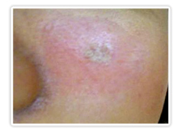 Qスイッチルビーレーザーの症例