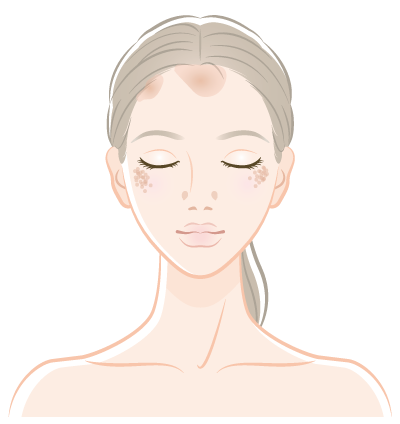 ADM(後天性真皮メラノサイトーシス）