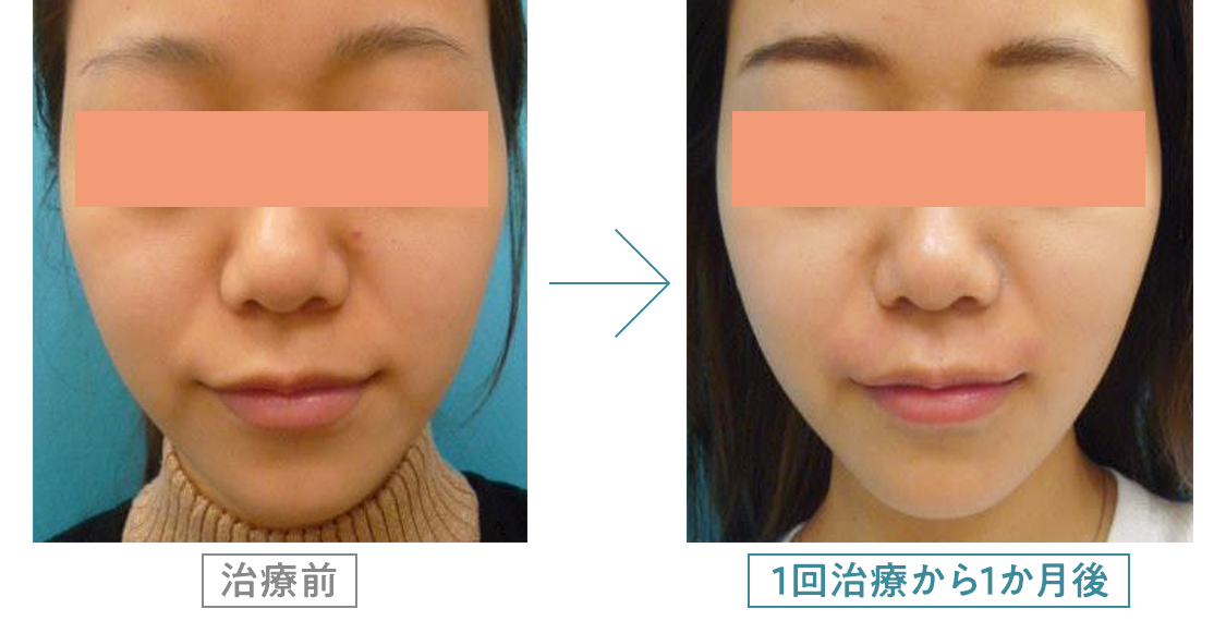 サーマクール治療症例