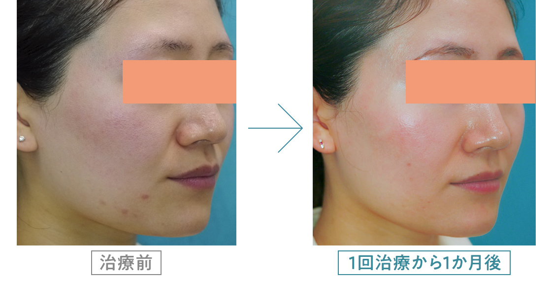 サーマクール治療症例