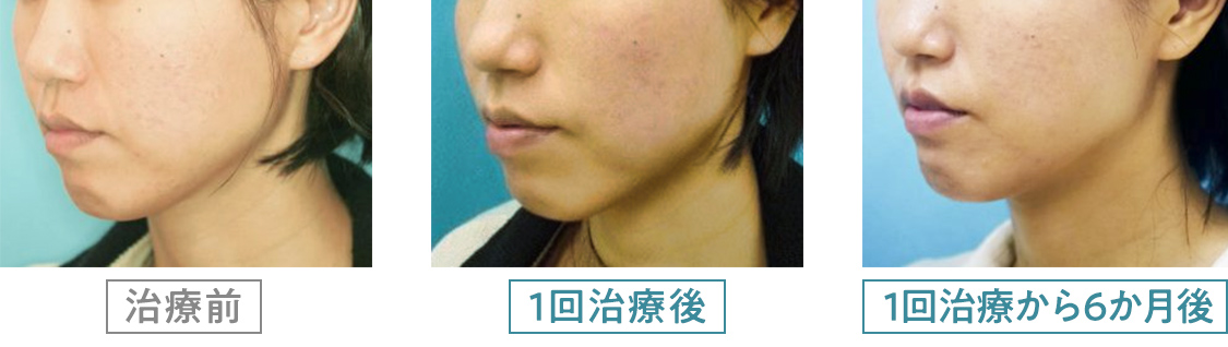 サーマクール治療症例