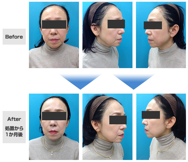 HIFU + 小顔ボトックス注射治療症例
