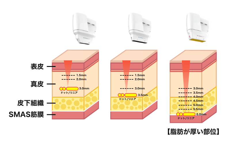 「0.5mm」単位で照射深度を調整可能に