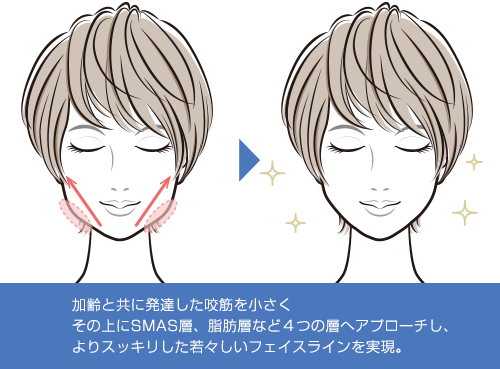 HIFU ＋小顔ボトックス注射