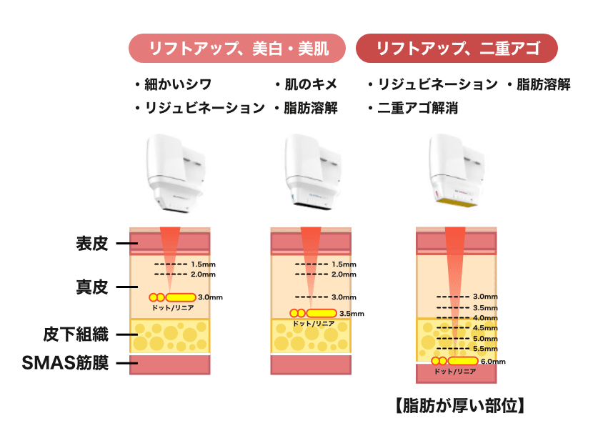 今まで難しかった眼窩周囲など狭い領域にも対応解剖学を熟知した医師が肌状態に合わせて照射深度を調整